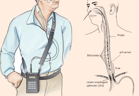Phương pháp đo pH thực quản 24 h đánh giá trào ngược